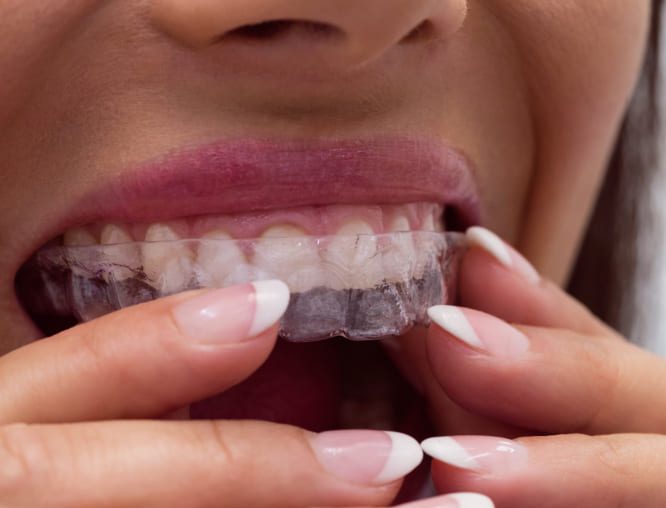 Ortodoncia invisible: lo mejor para alinear los dientes